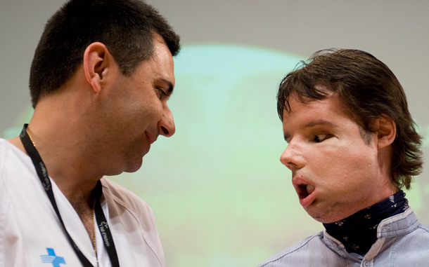 Oscar, the world's first full face transplant recipient, with medical staff at the Vall d'Hebron hospital in Barcelona. &ldquo;Bit by bit he is improving but he nonetheless has a long and difficult road ahead to have intelligible speech like he had before,&rdquo; Dr Barret said. (GETTY IMAGES)
