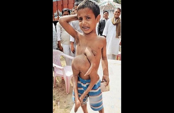 Eight year old Kumar Paswan from a remote Indian village who has an astonishing medical condition. (AGENCY)
