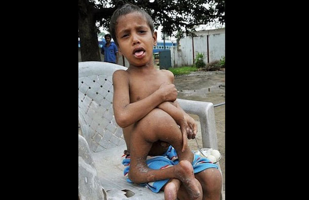 Eight year old Kumar Paswan from a remote Indian village who has an astonishing medical condition. (AGENCY)