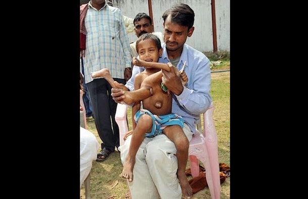 Eight year old Kumar Paswan from a remote Indian village who has an astonishing medical condition. (AGENCY)