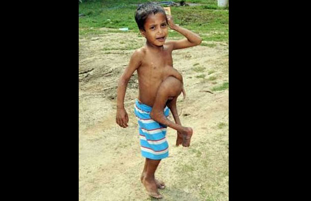 Eight year old Kumar Paswan from a remote Indian village who has an astonishing medical condition. (AGENCY)