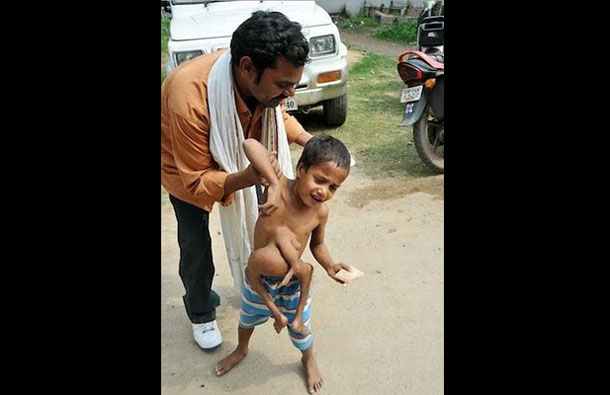 Eight year old Kumar Paswan from a remote Indian village who has an astonishing medical condition. One of our readers wrote in to say that the boy has been operated upon on December 6, 2010 and is now returning to normalcy. (AGENCY)