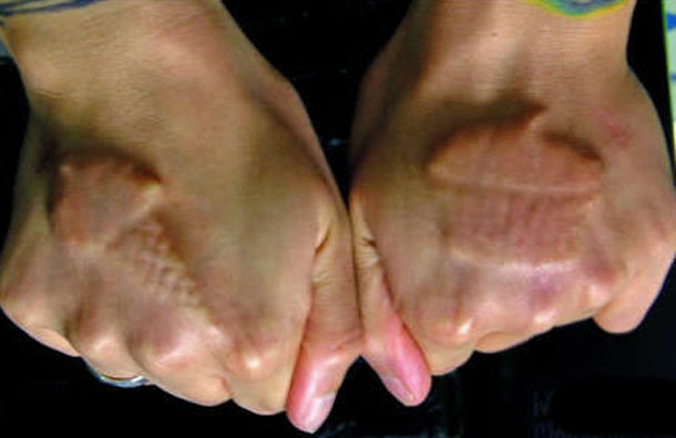 Body implants featuring an ice cream cone and a cupcake. (AGENCY)