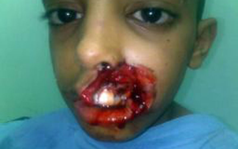 newsregiondog bites off child s upper lip 2011 11 19 1428985