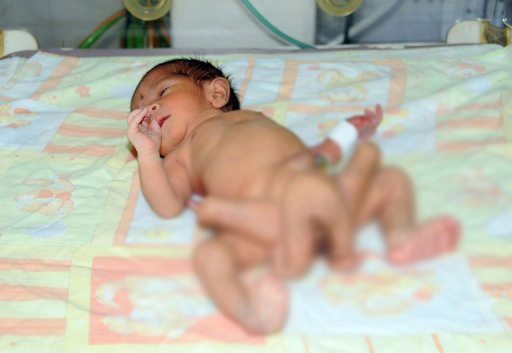 A newly-born child with six legs at a hospital in Karachi. (AFP)