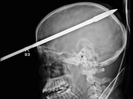 Doctors said the spear entered his head above his right eye, piercing the back of his skull. (AP)