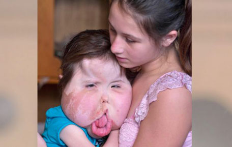 Girl's rare disability causes abnormally large facial features (AP