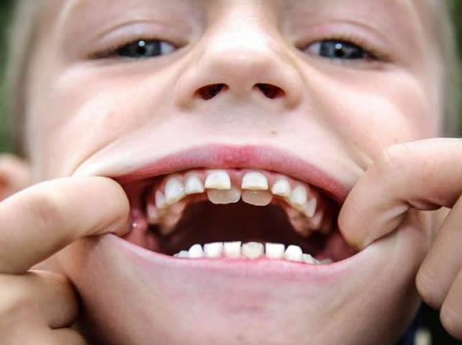 Doctores encuentran 526 dientes en la boca de un niño - CNN Video