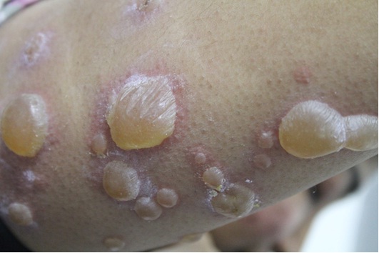 Large blisters on arm before treatment (Supplied)