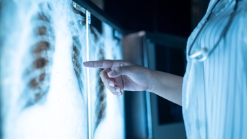 Photo: Scientists Discover Main Driver of Early-Stage Lung Cancer
